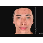 Tratamiento de Acne Dra. Olga Lucía Pardo