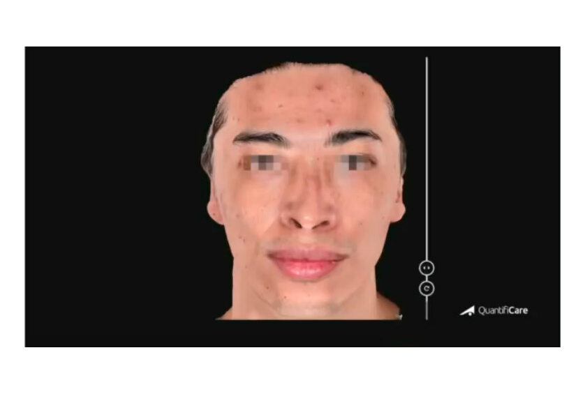 Tratamiento de Acne Dra. Olga Lucía Pardo