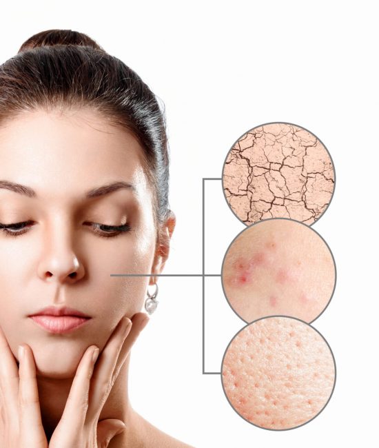 Young woman with acne, dry skin, black dots skin in zoom circle . Skin care concept. Young girl, beauty portrait. Close-up.